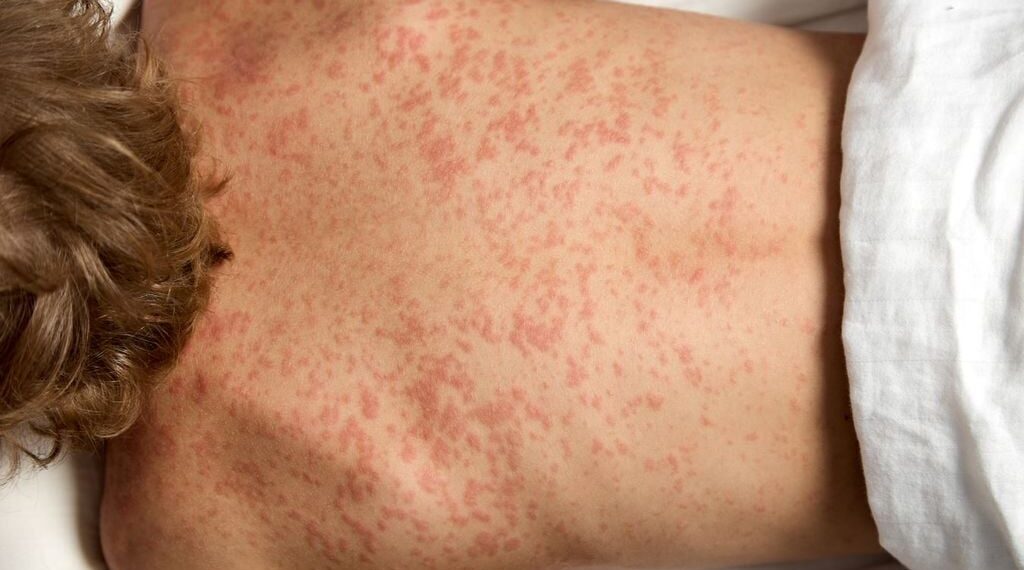 Hay 18 casos de sarampión en Chihuahua: Salud