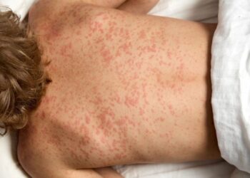 Hay 18 casos de sarampión en Chihuahua: Salud